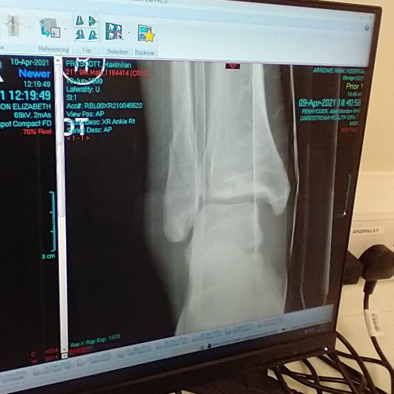 talar shift (displacement of the ankle) is evident and circled area shows spiral fracture on the fibula.png